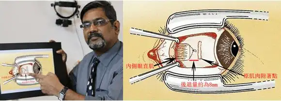 斜视手术商业保险报销吗 斜视矫正手术商业保险