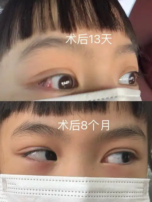 儿童斜视矫正手术8个月复查对比