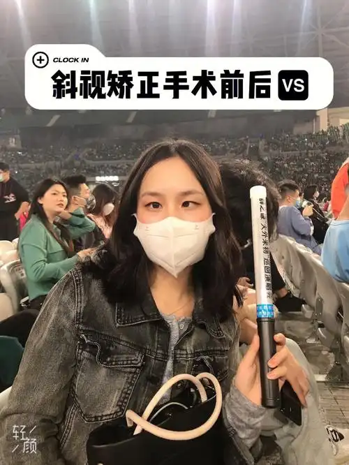 大～矫正后确实发现自己眼睛比之前拍照好看很多#斜视手术  #斜视矫正