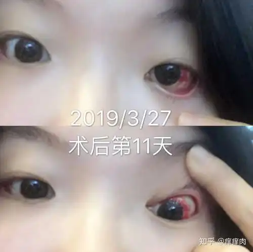 超过20岁了还能做斜视矫正手术吗?矫正后会出现哪些后遗症?